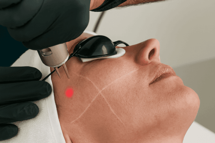 Fotona Laser Rejuvenation – Facial Tightening & Glow 4